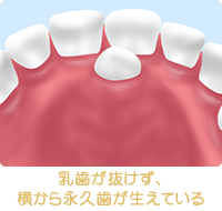 乳歯が抜けず、横から永久歯が生えている