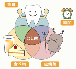 虫歯のなりたちについて