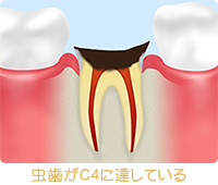 虫歯がC4に達している