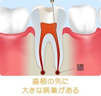 歯根の先に大きな病巣がある
