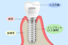 インプラントを長持ちさせる方法