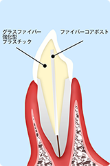 歯を補強する「コア」について